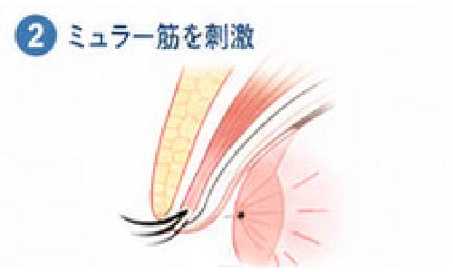 ミュラー筋を刺激