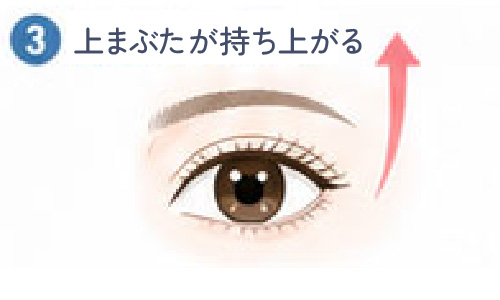 上まぶたが持ち上がる